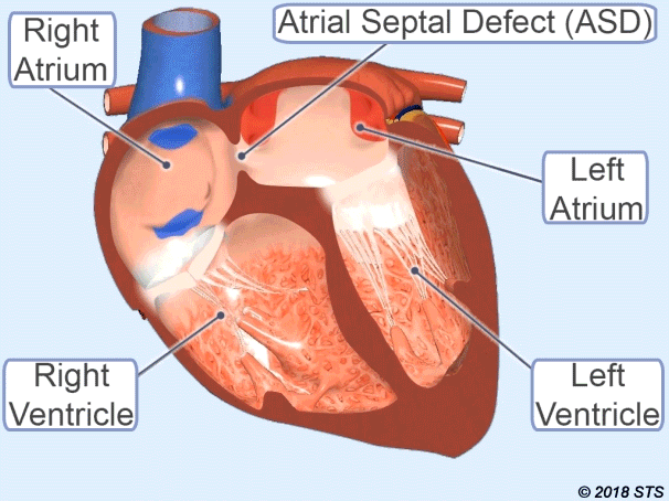 Atrial Septal Defekt (ASD)