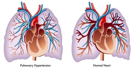 Hipertansif Kalp Hastalığı