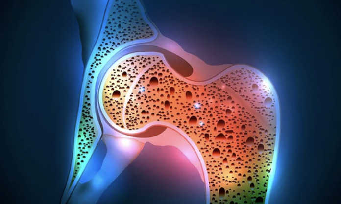 Kemik Erimesi (Osteoporoz)