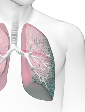 Lung Hardening (Idiopathic Pulmonary Fibrosis (IPF))