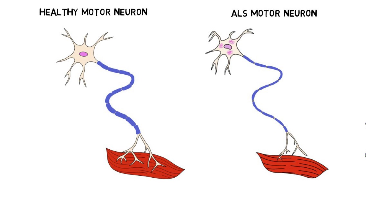 ALS (Amyotrofik Lateral Skleroz)