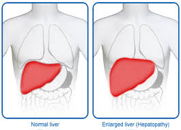 Liver Growth (Hepatomegaly),