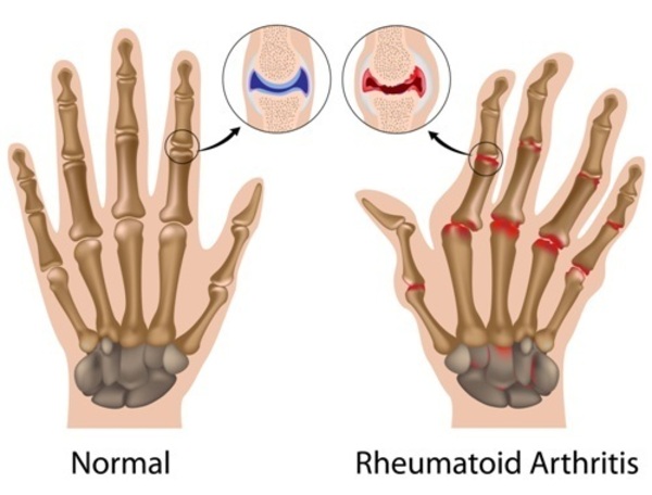 rheumatoid-arthritis-hands