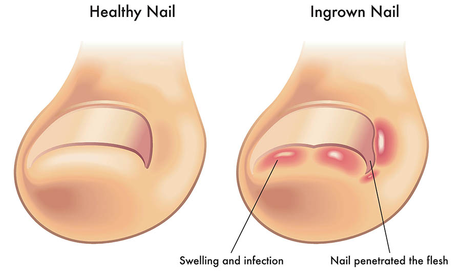 Ingrown nail
