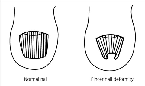 Pincer Nail