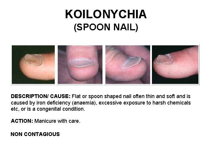 Spoon nail