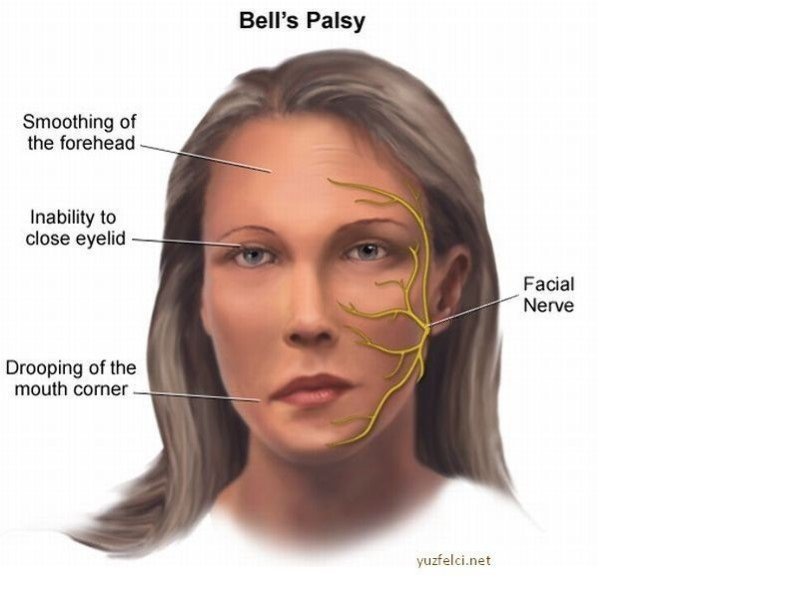 facial paralysis