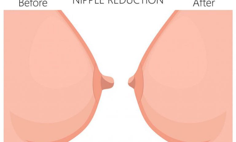 Nipple Aesthetics