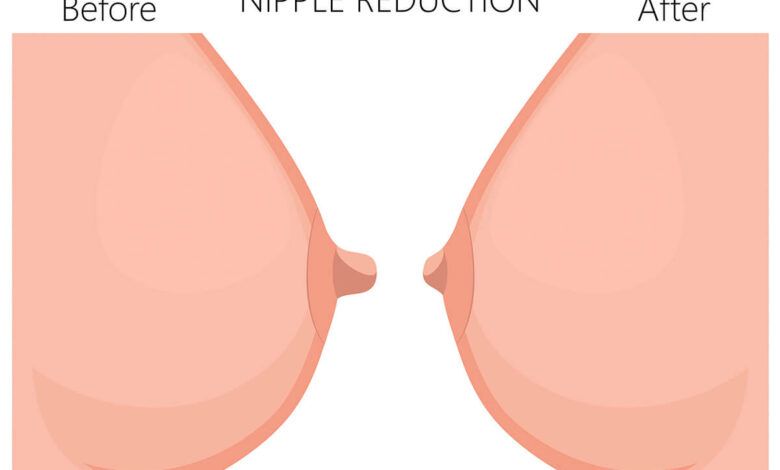 Nipple-Surgery