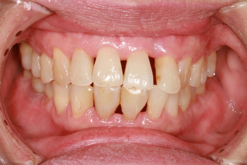 what-is-periodontitis