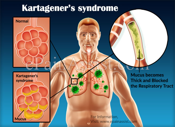 Kartagener Syndrome