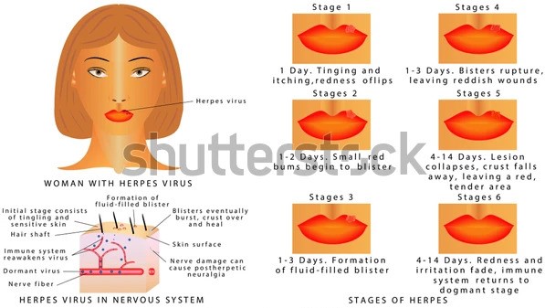 herpes virus infections