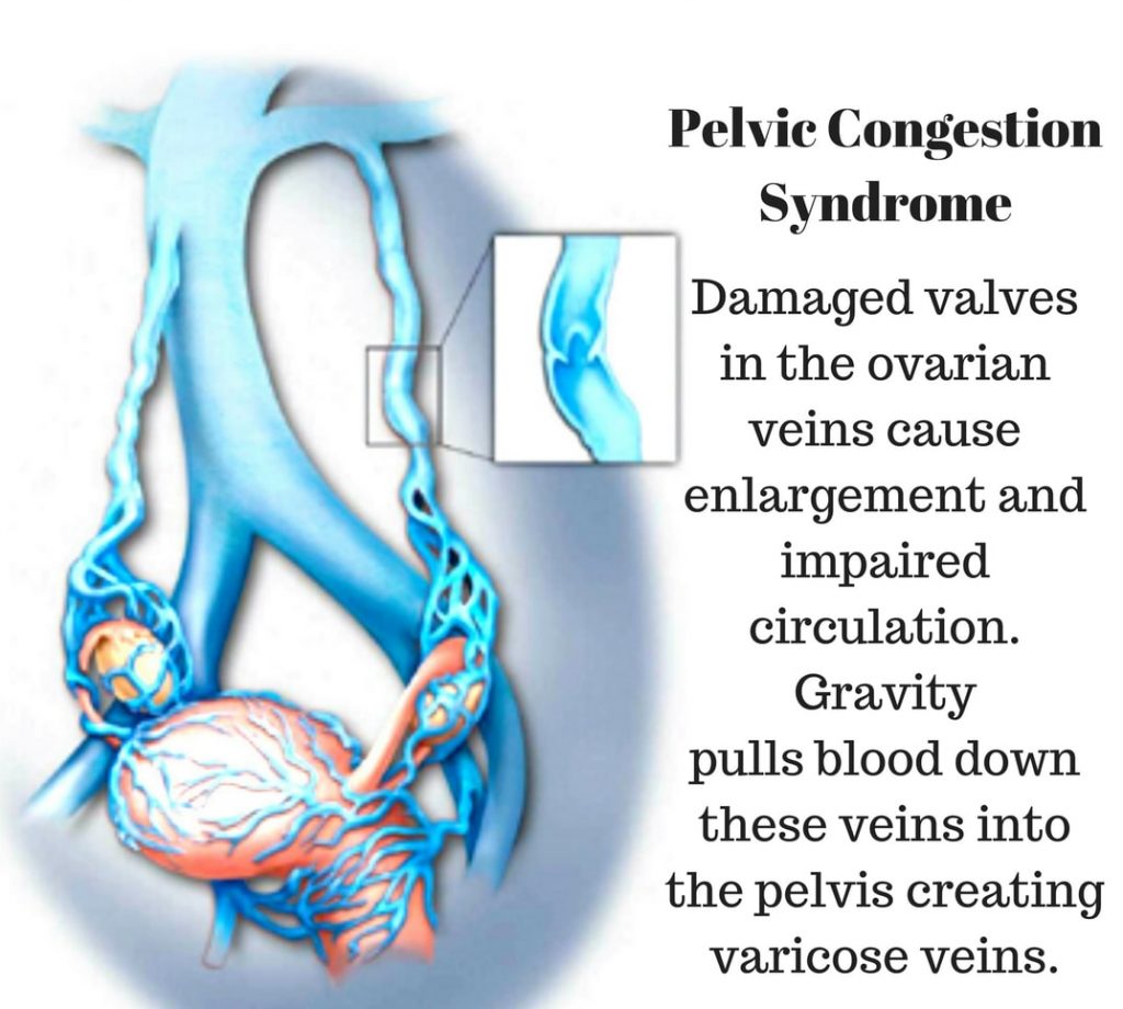 Pelvic congestion syndrome and ovarian cancer: Connection