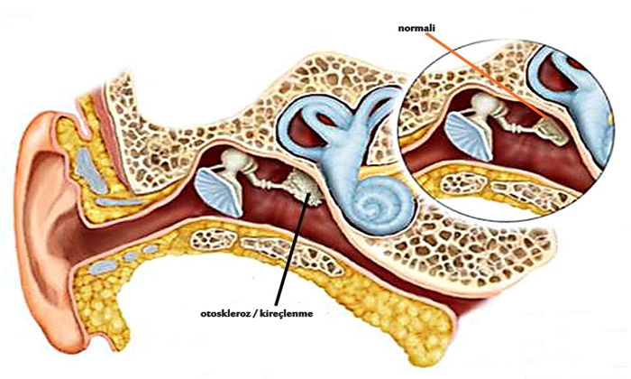 otoskleroz