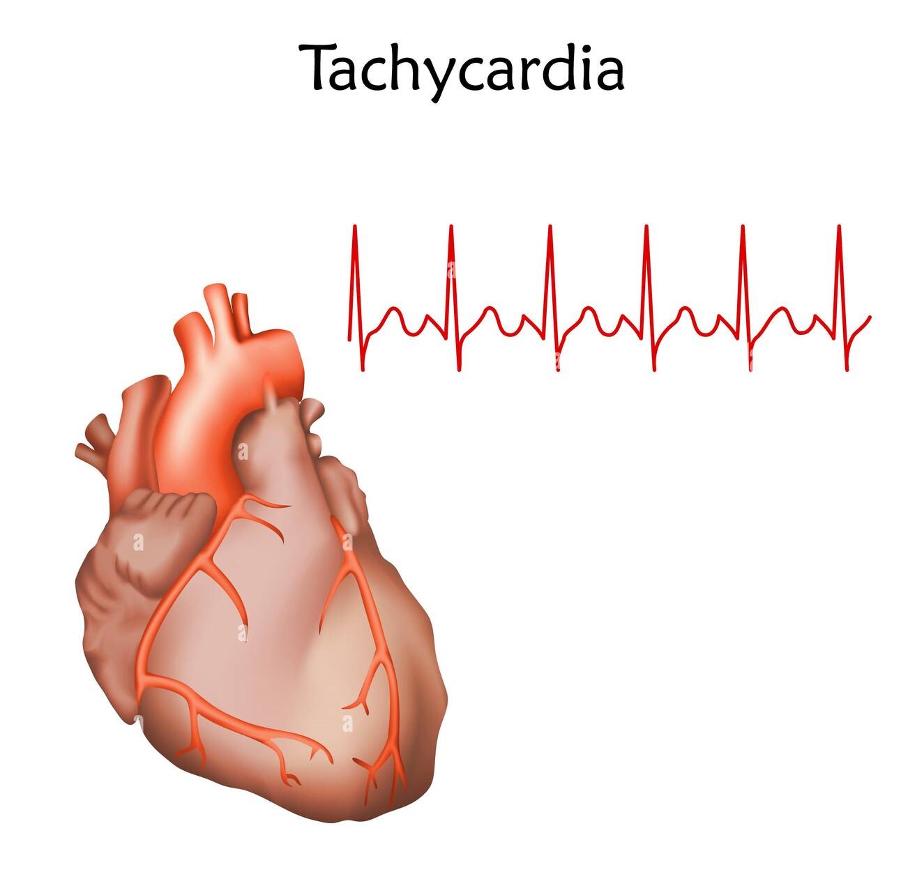 Tachycardia