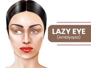 Lazy Eye (Amblyopia)