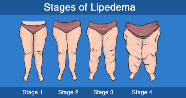Lipedema Stages