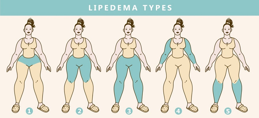Lipedema (also known as Lipoedema or Lipodema) is a pernicious