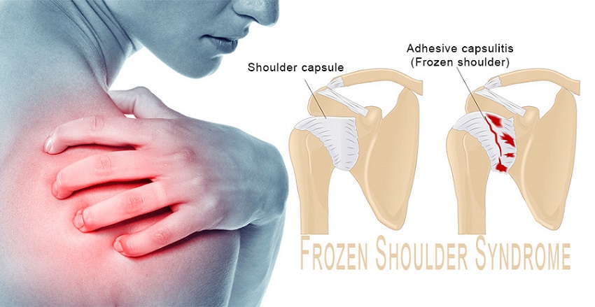 Frozen Shoulder Syndrome