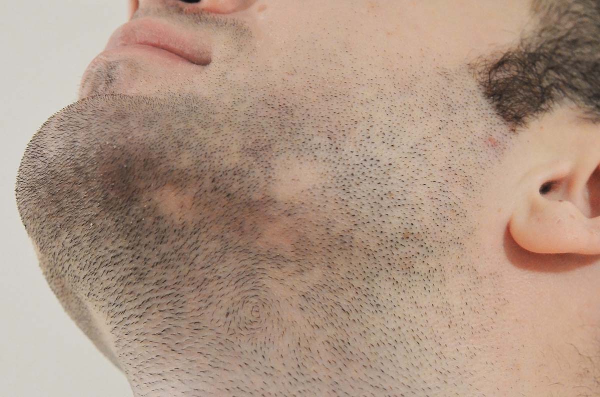 Beard transplant