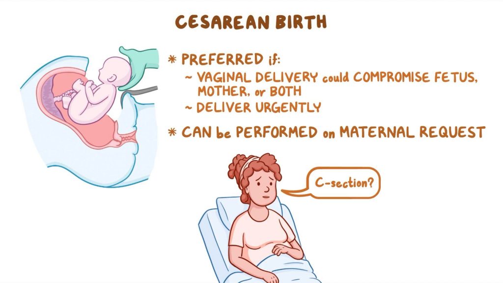 Cesarean Birth