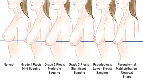 ptosis-sagging-breasts