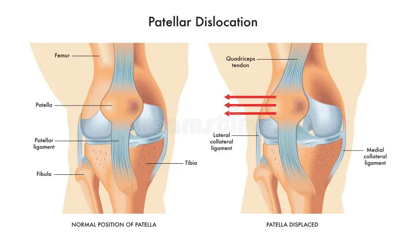 Patella Dislocation