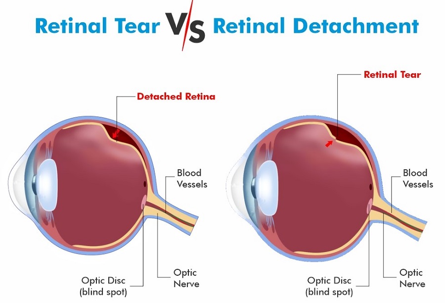 Retinal Detachment and Retinal Tear