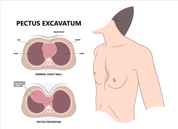 Pectus Excavatum