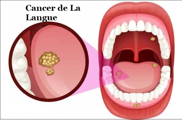 Cancer de La Langue