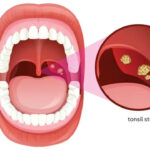 Tonsil Stone