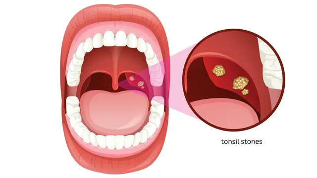 Tonsil Stone