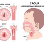 Croup