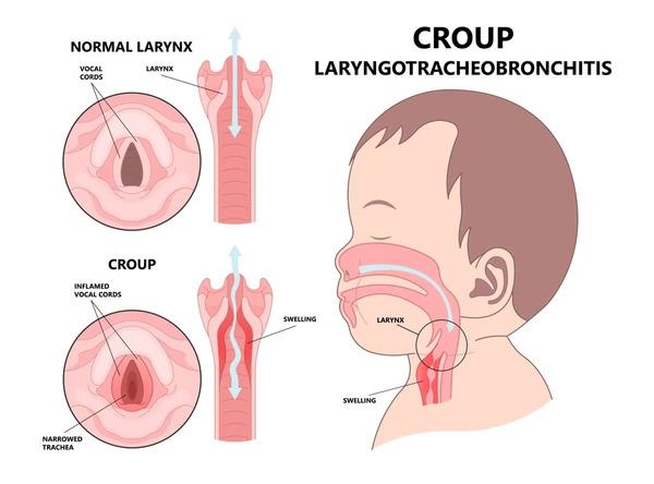 Croup