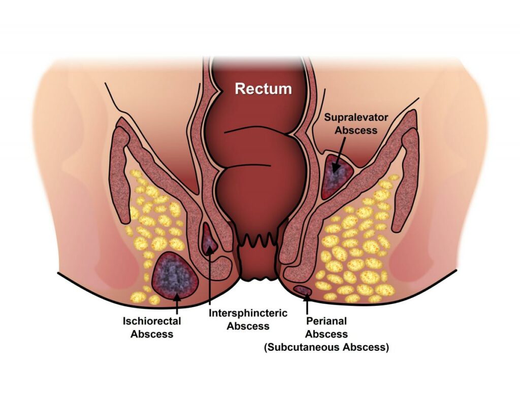 Anal Abscess