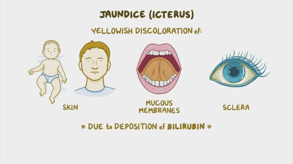 Jaundice