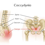 Coccyx Pain