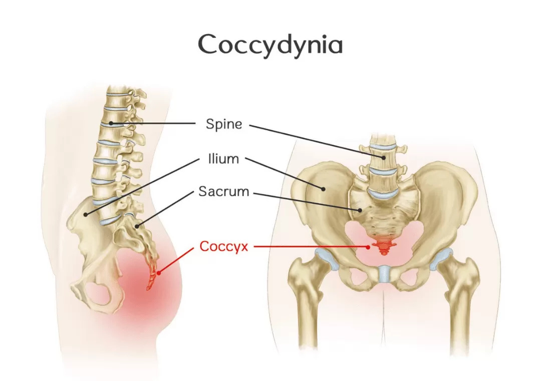 Coccyx Pain